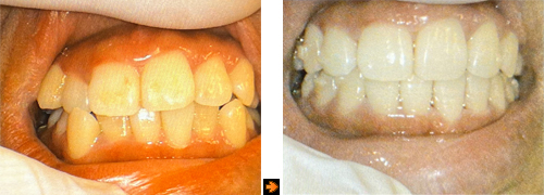 invisa1c