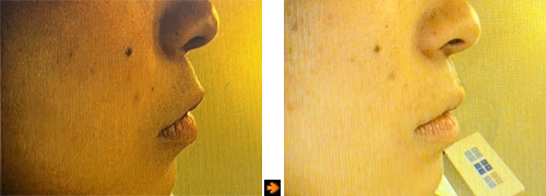 invisa25face