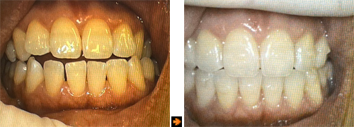 invisa5c